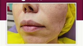 لیفت صورت با نخ لیپوماتیک