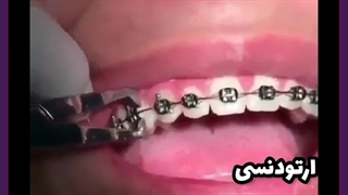 قالب‌ گیری ارتودنسی چقدر طول می‌کشد