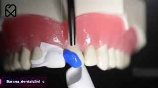 ترمیم دندان شکسته جلو