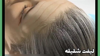 لیفت شقیقه بهتره یا بلفاروپلاستی