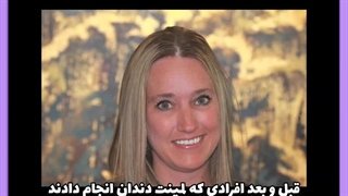 علت بوی دهان بعد از لمینت