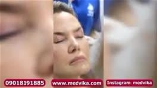 نحوه کاشت ابرو در مشهد