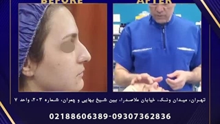 جراحی بینی بدون بی هوشی