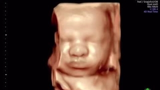 سونوگرافی چهاربعدی در هفته 37 بارداری
