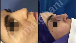 عمل رینوپلاستی