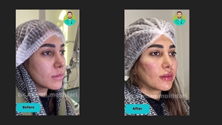 نمونه کار فیلر گونه