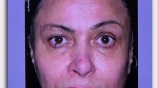 1ماه پس از لیفت صورت و گردن ، لیفت اندوسکوپی پیشانی و ابروها و عمل 4پلک