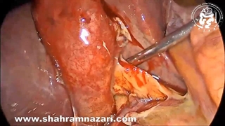 Acute Cholecystitis Impact of blunt dissection