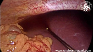 پریتونیت صفراوی