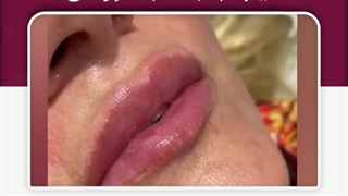 فیلر لب به سبک روسی