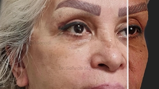 لیفت صورت (فیس لیفت)