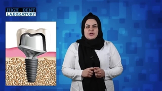 اباتمنت اختصاصی یا استاندارد (آموزش دندانسازی)