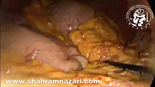 لاپاروسکوپی تومور جیست (GIST)معده