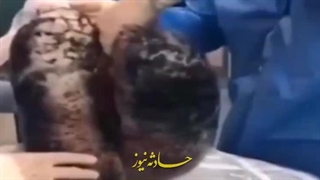 چه بلایی سر ریه یک فرد سیگاری میاد؟