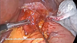 Laparoscopic Heller myotomy EGJ Perforation treated by Belsey fat pad suturing