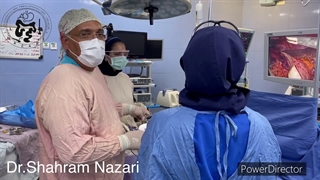 انواع آشالازی