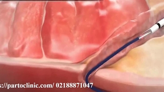 فیلم لیزر فیستول-partoclinic.com