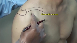 تزریق شانه یخ زده