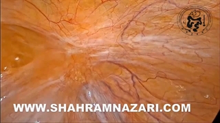 فتق اینگوینال مستقیم چپ