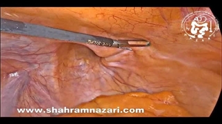 عمل لاپاروسکوپی فتق کساله ران
