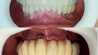 ایمپلنت در تهران