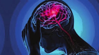 چرا مغز ما از بین میرود دلیل سکته مغزی چیست؟