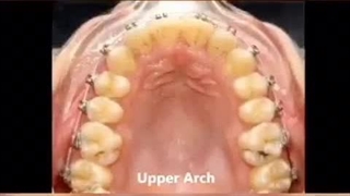فیلم ارتودنسی قبل و بعد دندان