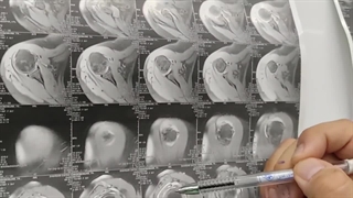 جراحی پارگی تاندون روتاتور کاف شانه