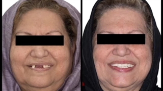 رویای ایمپلنت آسان