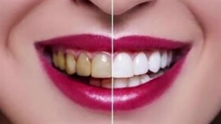 چرا دندان ها پوسیده می‌شود و بهترین درمان برای خرابی دندان ها چیست؟