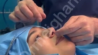 جراحی بینی با بی حسی